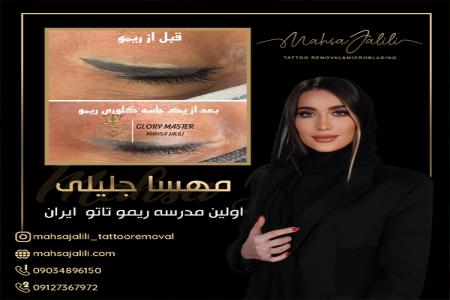 ریموو تاتو خط چشم با ریموور برند گلوری