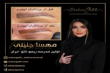 ریموو تاتو های قدیمی بدون لیزر