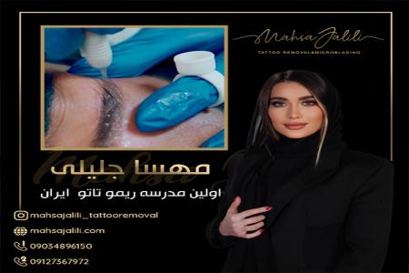 ریموو تاتو های قدیمی بدون لیزر