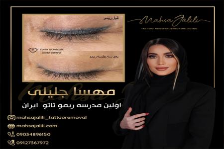 ریموو تاتو خط چشم با ریموور برند گلوری