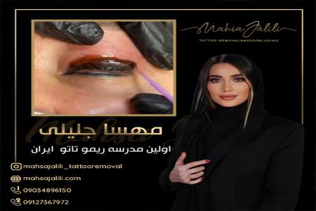 ریموو تاتو خط چشم با ریموور برند گلوری