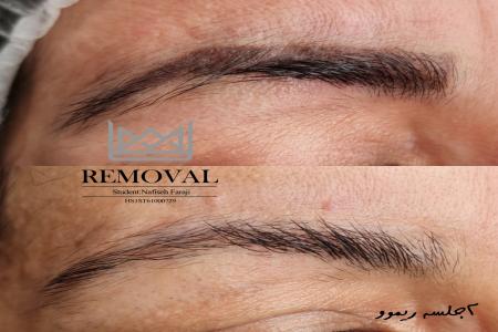 ریموو تاتو ابرو در تهران با بروزترین تکنیک های پاک کردن تاتو