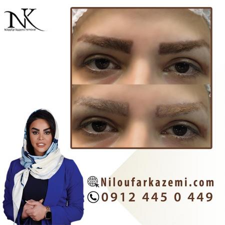 قیمت ریموو تاتو در مرکز ریموو تاتو نیلوفر کاظمی