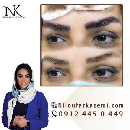 ریمووتاتو قدیمی با تکنیک های تخصصی