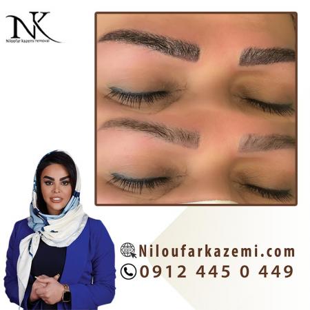 آمورش ریموو تاتو با بروزترین تکنیک کاملا تضمینی