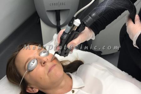 دستگاه لیزر مو های زائد