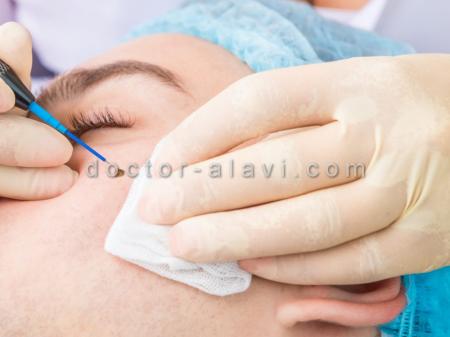 برداشتن خال و ضایعات پوستی