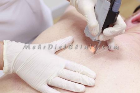 لیزر مو های زائد غرب تهران