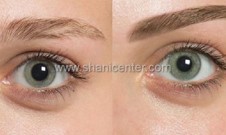 میکروبلیدینگ ابرو سهروردی